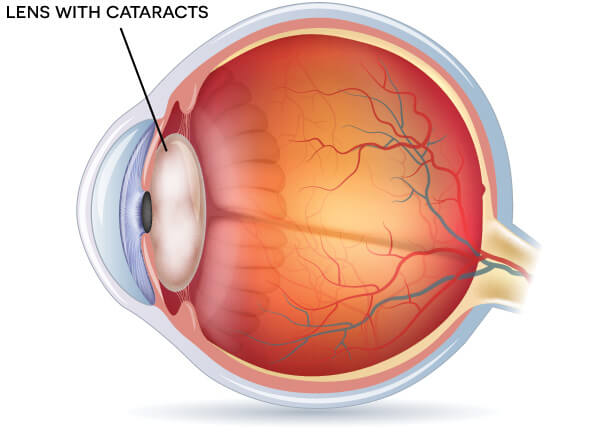 Eye With a Cataract