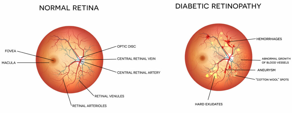 Chart illustrating a normal retina compared to one with diabetic retinopathy