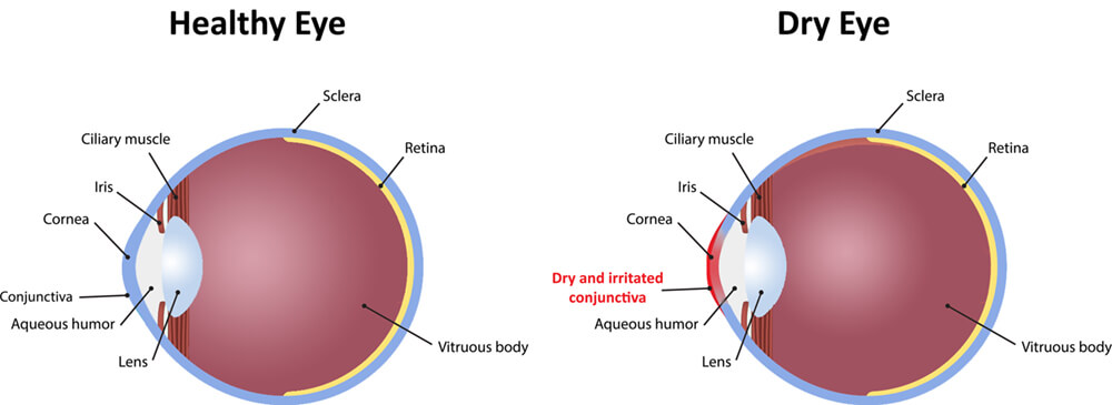 Chart showing a healthy eye vs one experiencing dry eye