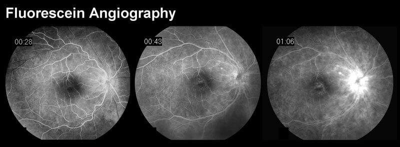 Fluorescein Angiography Scan