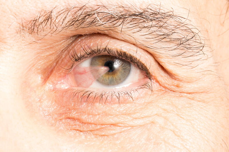 Closeup of Pterygium in an eye