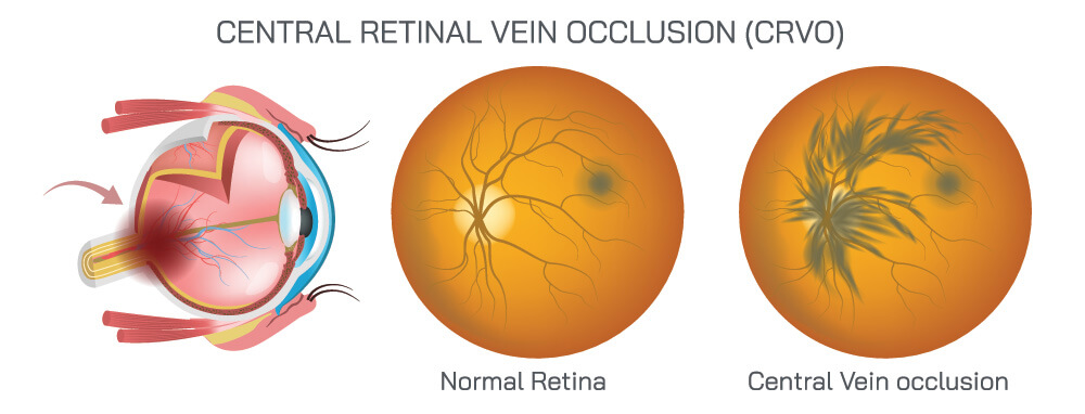 Chart showing a normal retina compared to one with a central vein occlusion